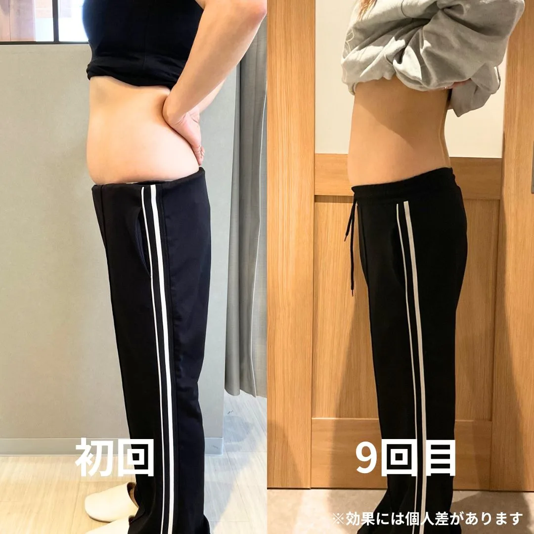痩身メニュー 施術前後の変化(側面)